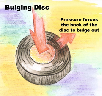 Your discs help to allow for motion and proper function of your spine.